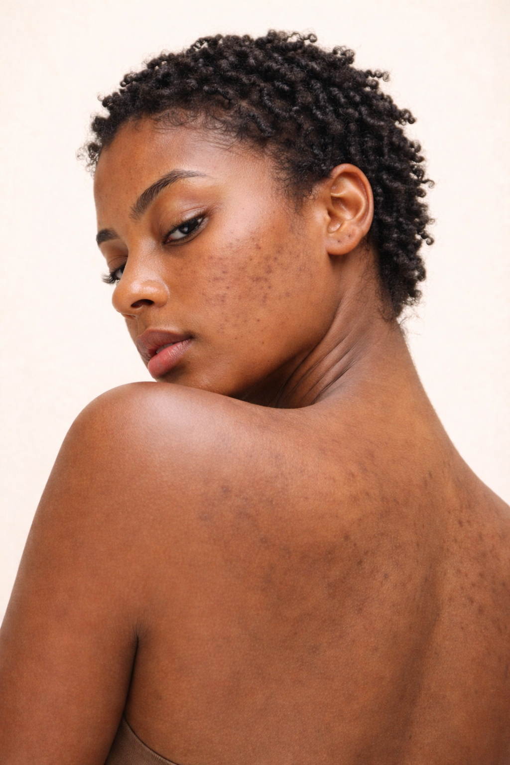 Best Laser for Acne Scars in Chilliwack: What Actually Works