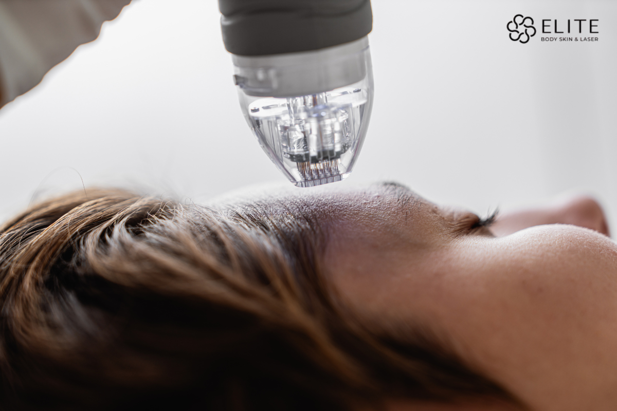 Microneedling clinic in chilliwack