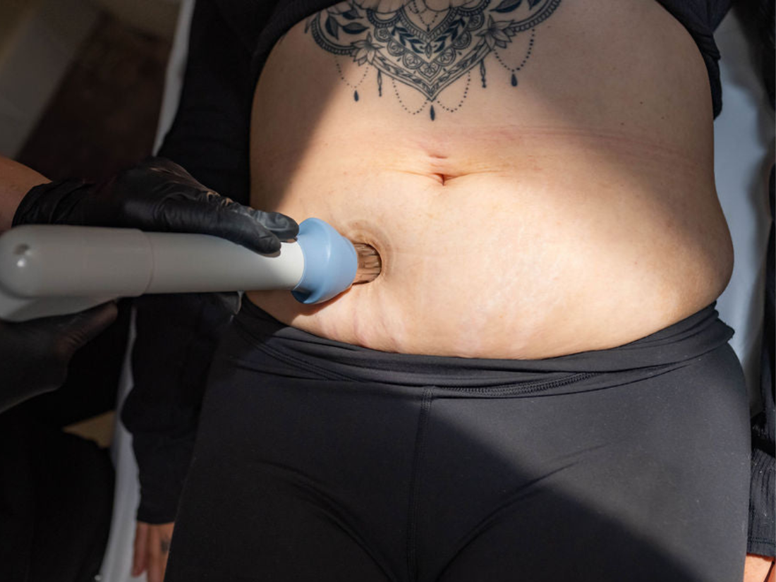 Cellulite Treatment in Chilliwack: How Cellutone Works to Smooth Skin Naturally