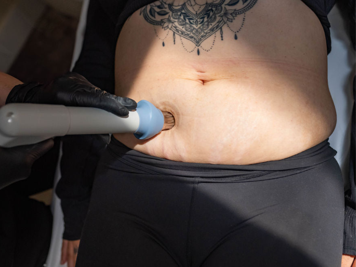 Cellulite Treatment in Chilliwack: How Cellutone Works to Smooth Skin Naturally