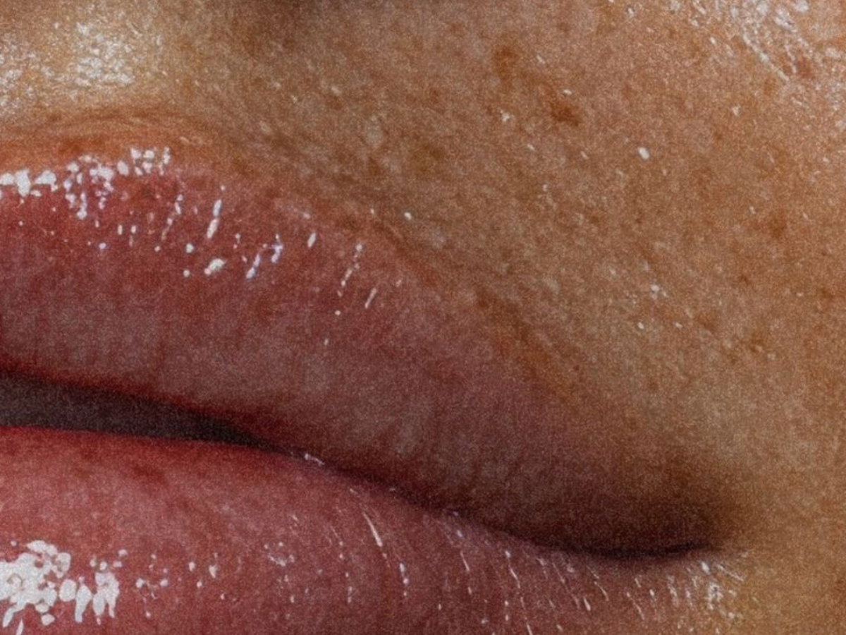 Laser skin rejuvenation treatment for pigmentation and sun damage at Skin Co Aesthetics in Chilliwack