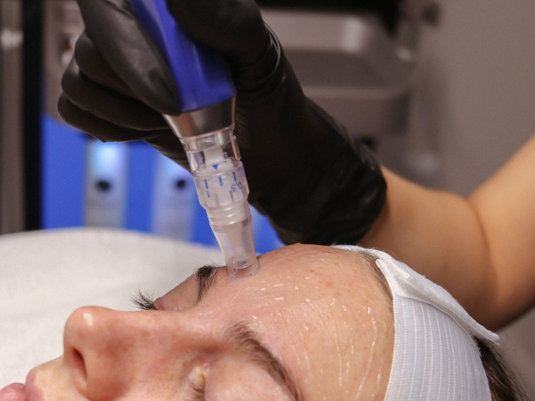 Microneedling in Chilliwack: Benefits, Results, and What to Expect