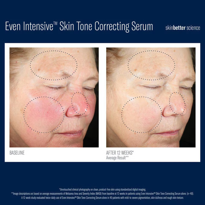 Skinbetter Even Intensive Skin Tone Correcting Serum